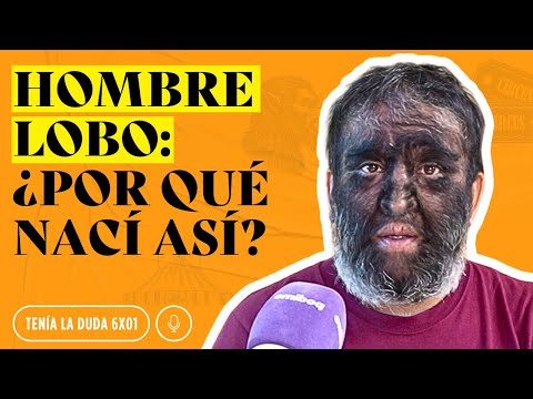 Me llaman «HOMBRE LOBO»: ¿Por qué nací así?