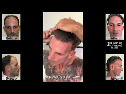 Nick Alberto Hair Transplant Journey