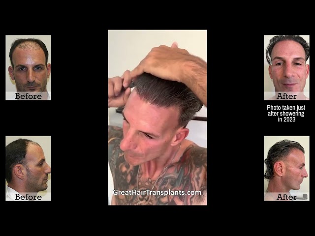 Patient Hair Transplant Video