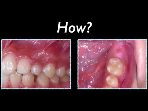 CC448. Surgical exposure and traction of impacted canine and second molar by IZC and Ramus