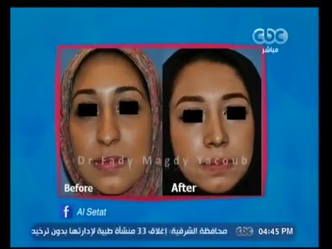 عمليات تجميل الأنف - حلقة فبراير الستات مايعرفوش يكدبوا #دكتور_فادي_مجدي_يعقوب