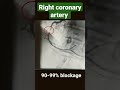 Right Coronary Artery With 80 90 90 99 And 100 Blockage Angiography Shorts
