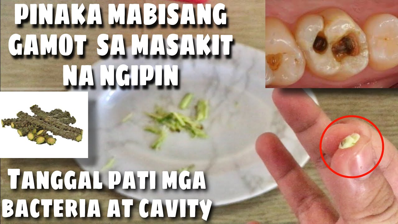 Putar video MABISANG GAMOT SA SAKIT NG NGIPIN | SUPER EFFECTIVE AND SAFE - Jery Napare sekarang MABISANG GAMOT SA SAKIT NG NGIPIN | SUPER EFFECTIVE AND SAFE - Jery Napare