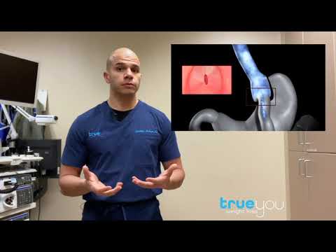 Endoscopic Gastric Bypass Revision Explained | How Transoral Outlet Reduction (TORe) Works