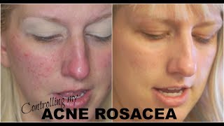 Acne Rosacea Skincare! What Finally Worked? Dermalogica Update #3