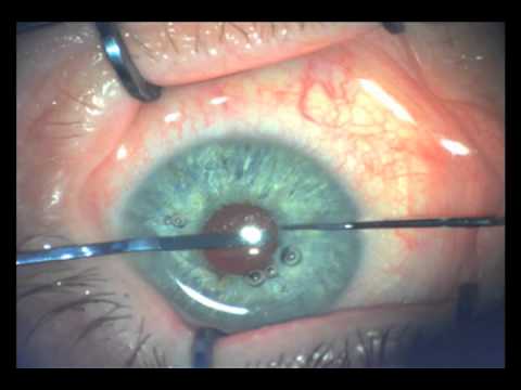 Artificial Iris Implantation 