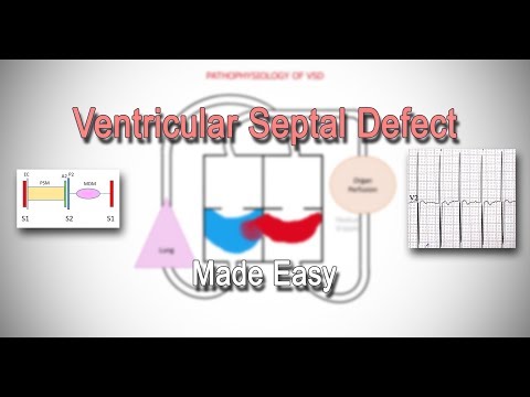Ventricular Septal Defect (VSD) | Classification | Pathophysiology | Clinical Features | Made Easy