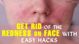 Get Rid Of The Redness On Face With Easy Hacks