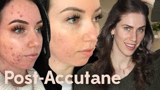 Post- Accutane Acne Skincare Routine
