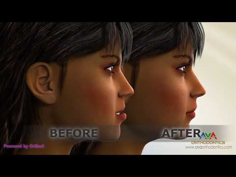 Orthodontic Treatment for Underbite or Crossbite - Removing Lower 2nd Premolars