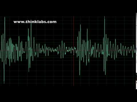 Bicuspid Aortic Valve with Mild Stenosis