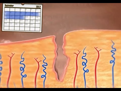 Analgetikum von Bandscheibenbruch Rückenschmerzen vom Hals abwärts