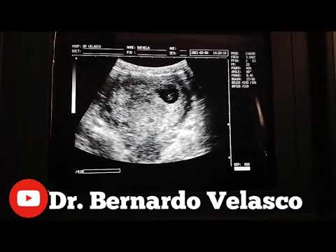6-WEEK GESTATION EMBRYO BY ULTRASOUND
