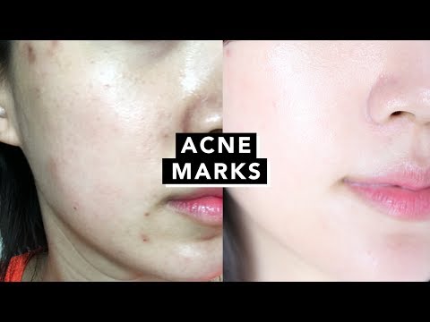 How I Got Rid of Acne Marks • Hyperpigmentation with $15 Video