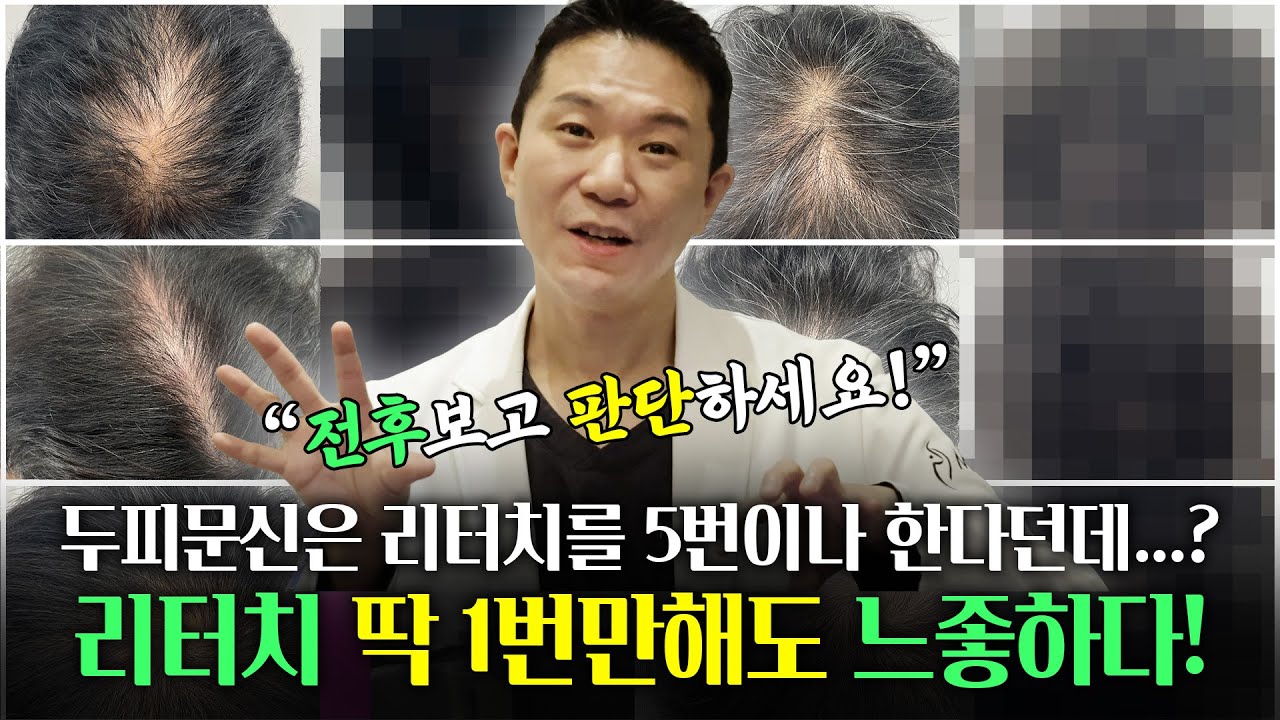 두피문신 리터치 한 번만 받아도 될까? 됩니다 (보고 판단하세요)