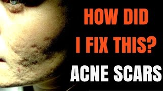 How to treat acne scars - Dermatologist explains