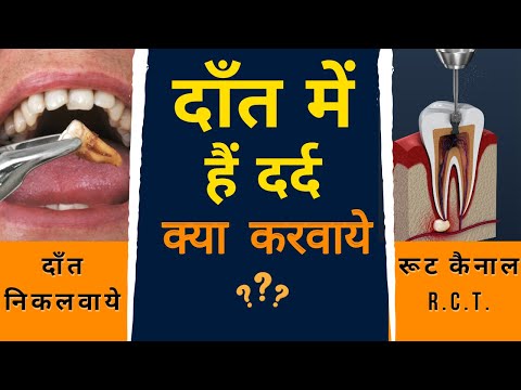 दाँत निकलवाये या रूट कैनाल (RCT) dant niklwaye ya RCT @dramitnkt best kya hai rct or dant niklwana.