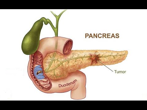 Zollinger-Ellison Syndrome