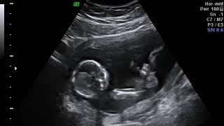 Rosa Perez - La BEBE ... Gloria a Dios !! 🗣