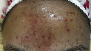 Effects Of Popping Pimples