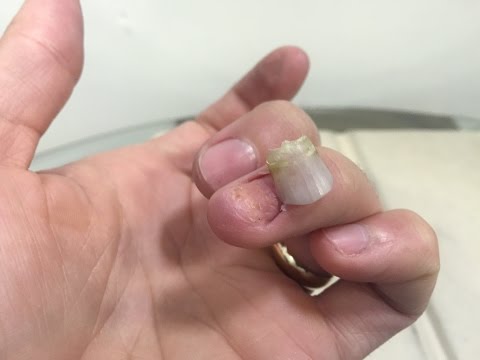 Lotseril upang ilapat ang kulay ng kuko Ointment ekzoderil presyo Orenburg