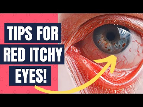 How To Get Relief From Allergic Conjunctivitis or Itchy Red Eyes