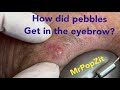 Pocket full of Pebbles cyst. One of a kind pebble pop! You’ve never seen a pebble cyst pop before.