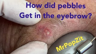 Pocket full of Pebbles cyst. One of a kind pebble pop! You’ve never seen a pebble cyst pop before.