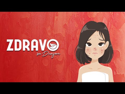 ZDRAVO SA DUNJOM – Kako uspešno izlečiti akne i bubuljice?