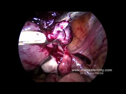 Laparoscopic resection of cornual ectopic pregnancy