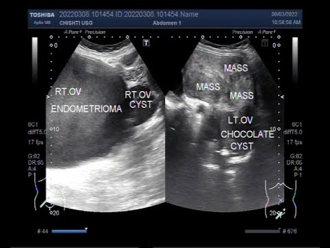 Understanding the different types of Ovarian Cysts.