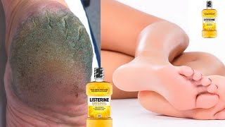 This Listerine & Vinegar Foot Soak is Magic for Dry Heels| GET RID OF DRY, SCALY FEET