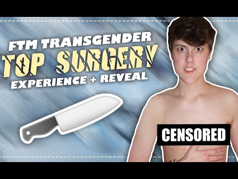 MY FTM TOP SURGERY EXPERIENCE
