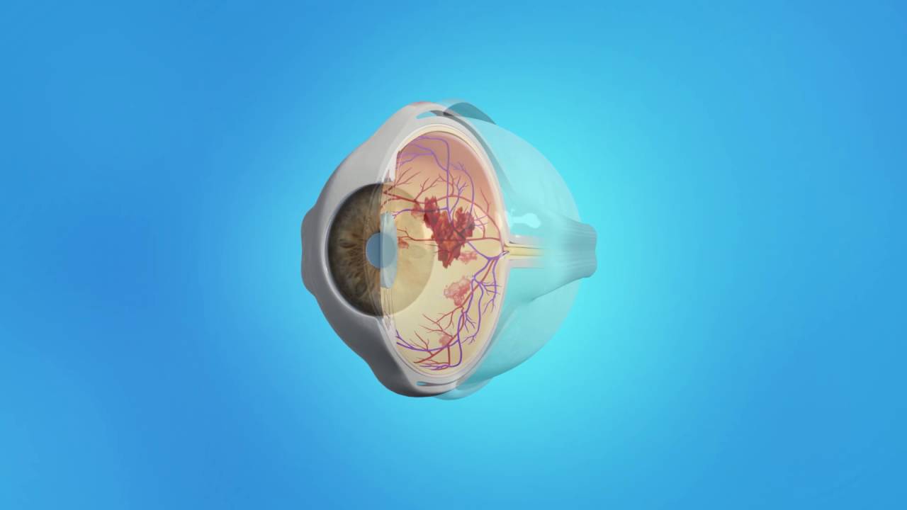 Diabetic Eye Disease (PDR) Vitrectomy