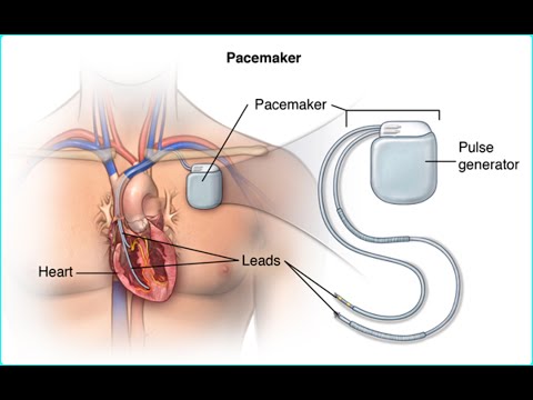What is pacemaker how to work and Working Principle Advantage and Disadvantage