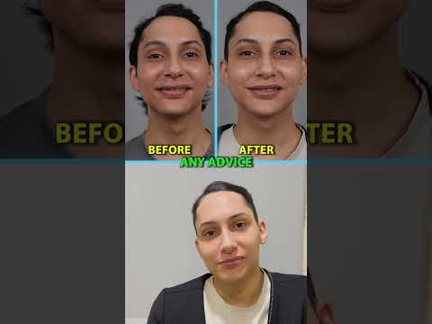 My INCREDIBLE Lip Lift Result