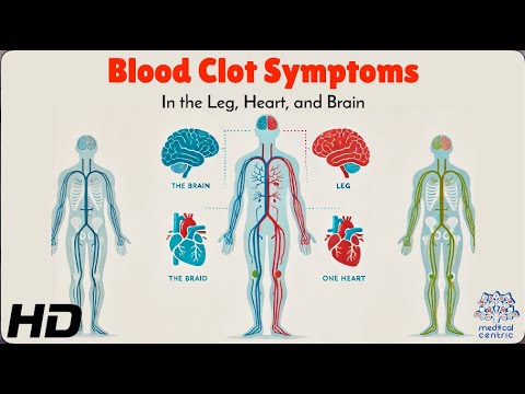 Don't Ignore These Blood Clot Warning Signs in Your Body