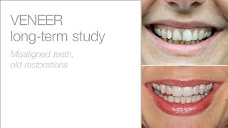 Edelweiss long-term study / Patient story