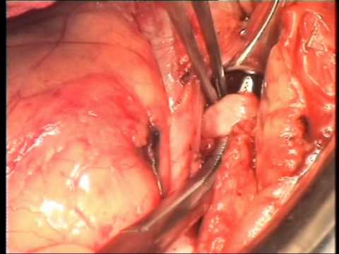 Nephrectomy With Thrombectomy Of Inferior Vena Cava Occlusion  