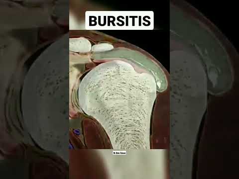 Bursitis #bursitis #bursa #inflammation #physicaltherapy#shoulder #pain #shorts #movement #anatomy