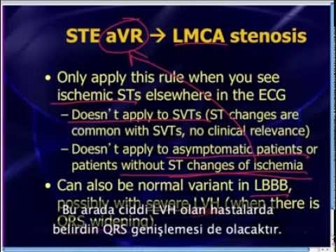 Mattu EKG Vakası: aVR Nasıl Okunur? 6 Mayıs 2013 Türkçe Altyazılı - Acilci.Net
