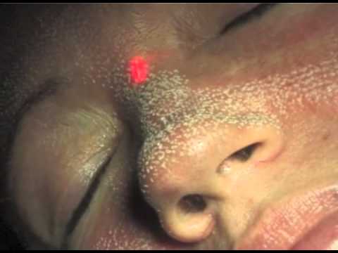 Sollevamento di un midface per risposte di sezione subciliari La faccia schiarente imballa il deposito in linea