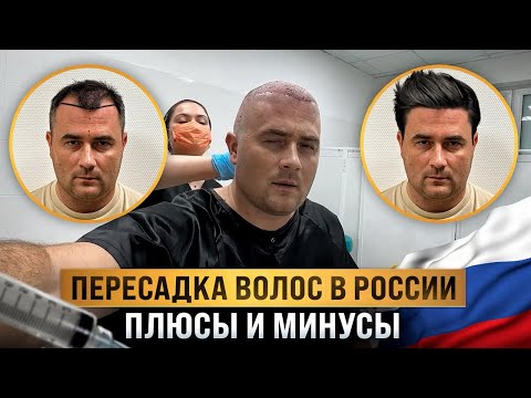 ПЕРЕСАДКА ВОЛОС В РОССИИ, ПЛЮСЫ И МИНУСЫ!