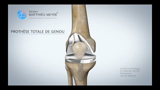PROTHÈSE TOTALE DE GENOU - DR MATTHIEU MEYER