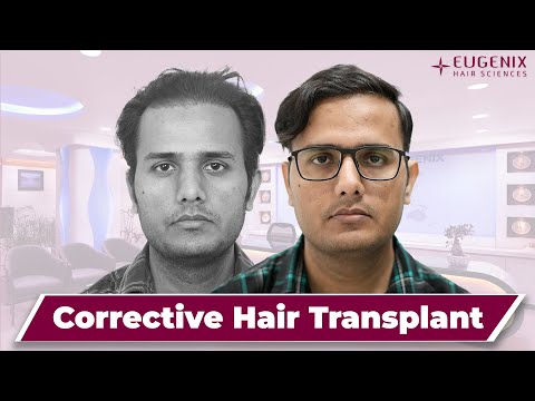 Corrective hair transplant bears fantastic results as...