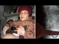 The Woman Who Carried a Fetus in Her Body for 60 Years (WARNING: Graphic Content)