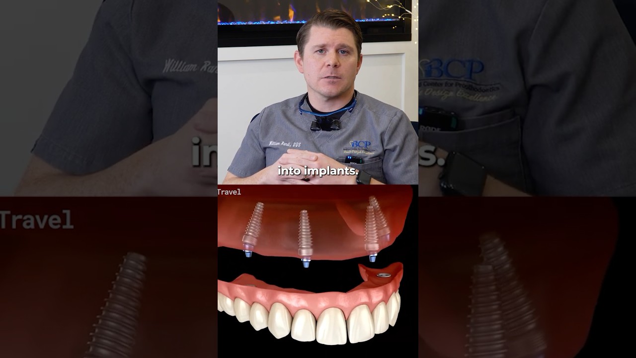 All-on-X Implants: Explained