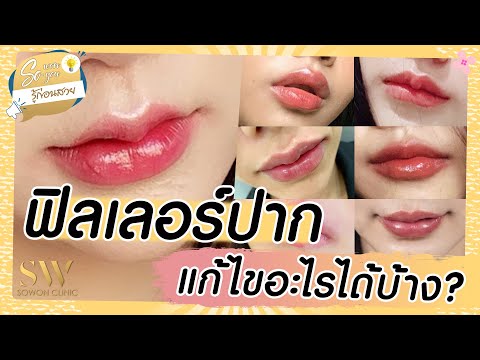 เมโสแฟต ยี่ห้อไหนดี