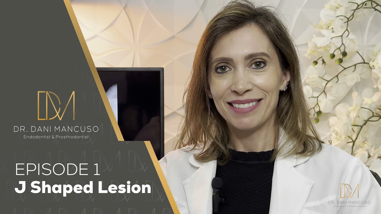 The Diary of an Endodontist - Episode 1 - J Shaped Lesion