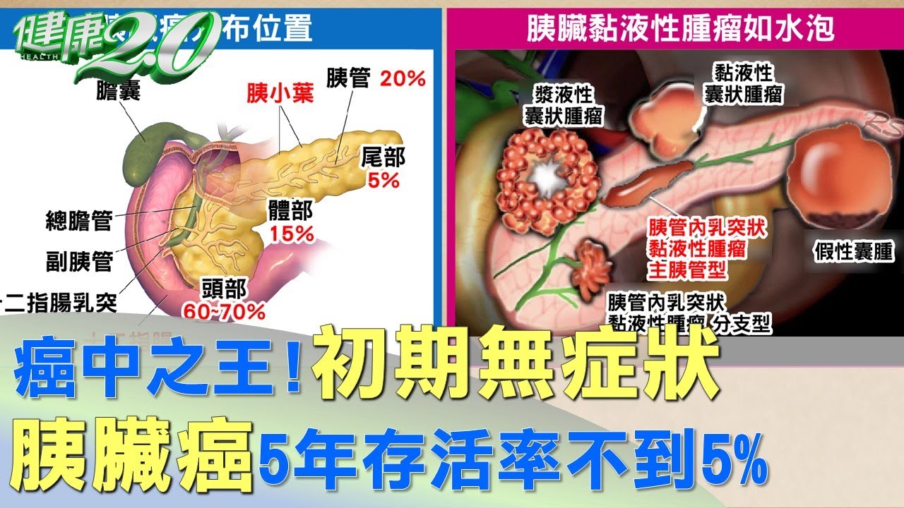 「胰臟長水泡」恐成腫瘤!凶猛癌王初期難察覺 5症狀當心
